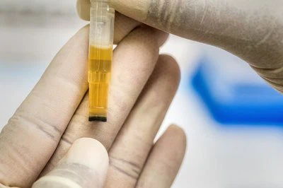 Microneedle texnologiyasi: biotibbiyot muhandisligining xoch-interfeys pardas...